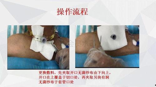 采血针的使用方法视频,轻松掌握采血技巧